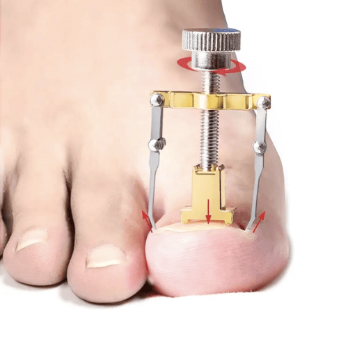 Korrigeringsskruv, nageltrång